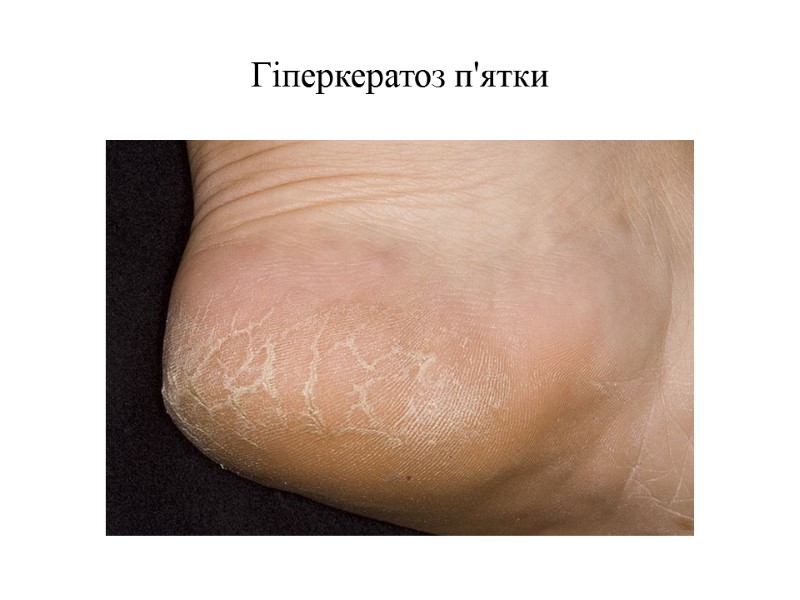 Гіперкератоз п'ятки